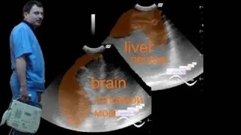 Нейросонография - Неонатальный геморрагический синдром смотреть онлайн