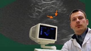 Нейросонография - Cубэпендимальная киста с пульсацией смотреть онлайн