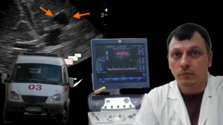 Нейросонография - Перивентрикулярная лейкомаляция смотреть онлайн