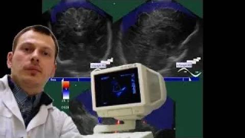 Нейросонография - Субдуральное кровоизлияние смотреть онлайн