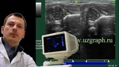 Детское УЗИ тазобедренных суставов - Подвывих тазобедренного сустава (тип III по Граф) смотреть онлайн