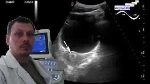 Детское УЗИ органов малого таза - Гиперэхогенный цервикальный канал