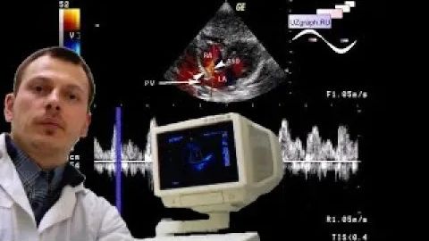 Детское УЗИ сердца (эхокардиография) - ДМПП типа sinus venosus смотреть онлайн