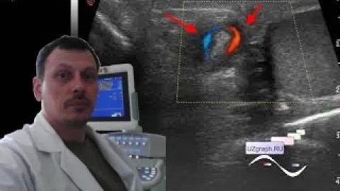 Детское УЗИ мошонки - Перекрут семенного канатика смотреть онлайн