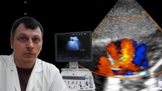 Детское УЗИ сердца (эхокардиография) - Фенестрация МПП / Множественные ДМПП смотреть онлайн