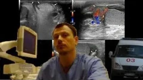 Детское УЗИ мошонки - Травматический эпидидимит смотреть онлайн