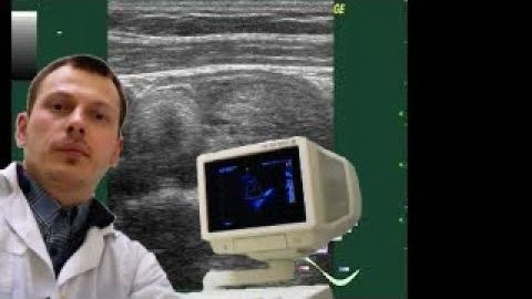 Детское УЗИ органов малого таза - Тератома яичника смотреть онлайн