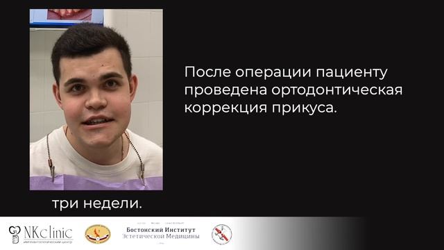 Ортогнатическая операция на челюсти. Исправление мезиального прикуса в NKclinic