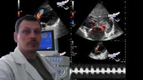 Детское УЗИ сердца (эхокардиография) - Дефект межжелудочковой перегородки (ДМЖП) смотреть онлайн