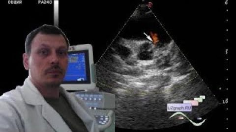 Детское УЗИ сердца (эхокардиография) - Коронарная фистула из левой коронарной артерии смотреть онлайн