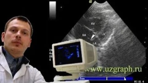 Детское УЗИ сердца (эхокардиография) - Увеличение правого сердца смотреть онлайн