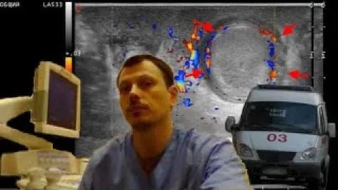 Детское УЗИ мошонки - Неполный перекрут яичка смотреть онлайн