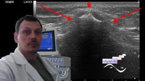 УЗИ коленных суставов - Последствия экстремальных видов спорта смотреть онлайн