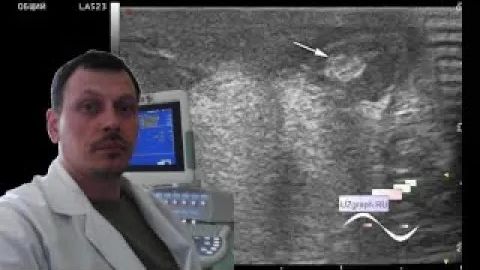 Детское УЗИ мошонки - Монорхизм, рудимент яичка смотреть онлайн