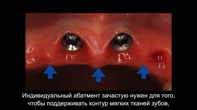 Что такое индивидуальный абатмент и для чего он нужен? | Блог #1 | NKClinic