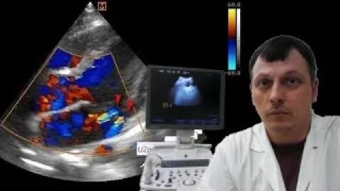 Детское УЗИ сердца (эхокардиография) - Двухструйная регургитация на митральном клапане смотреть онлайн