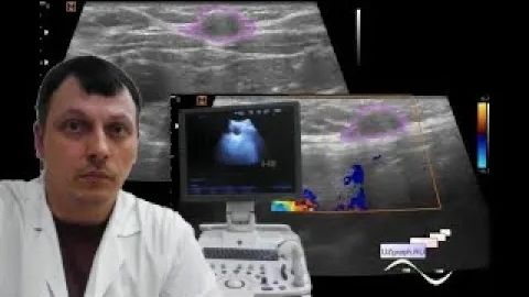 Детское УЗИ мягких тканей - Срединное образование шеи смотреть онлайн