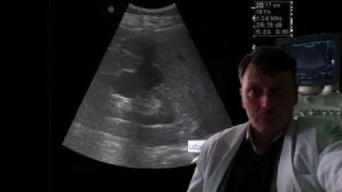 УЗИ почек - Кисты почки смотреть онлайн