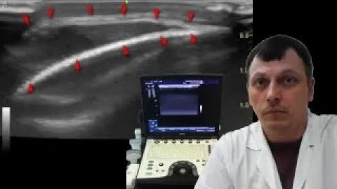 Детское УЗИ мягких тканей - Кефалогематома у новорожденного смотреть онлайн