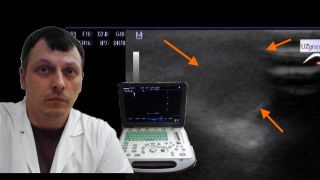 Детское УЗИ мягких тканей - Образованием в проекции носа смотреть онлайн