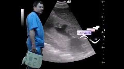 Детское УЗИ почек - Симптом белых почек смотреть онлайн