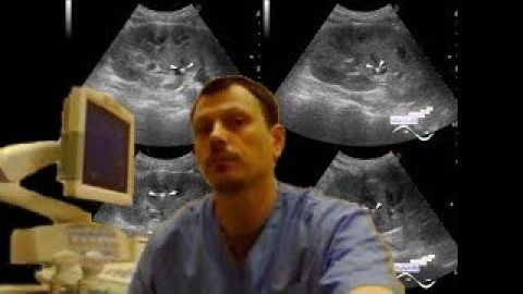 Детское УЗИ почек - Уролитиаз, острая боль смотреть онлайн