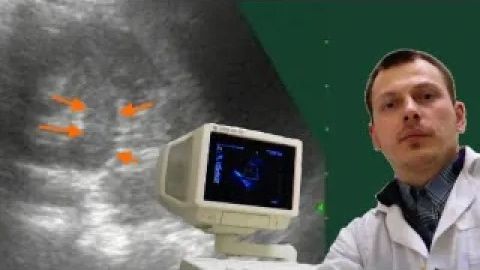 Детское УЗИ почек - Удвоение ЧЛС почки смотреть онлайн