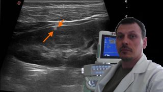 Детское УЗИ почек - Мелкая ангиомиолипома почки смотреть онлайн