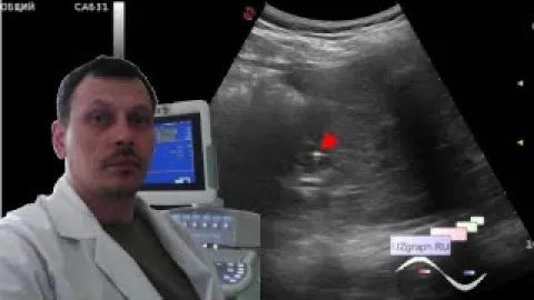 Детское УЗИ почек - Беременность и уролитиаз смотреть онлайн