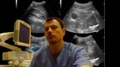 Детское УЗИ почек - Вентильный конкремент лоханки смотреть онлайн