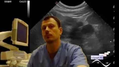 Детское УЗИ почек - Кистозная дисплазия, нефропатия, гематурия смотреть онлайн