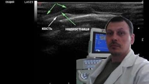 Детское УЗИ костей - Образование лобной области смотреть онлайн