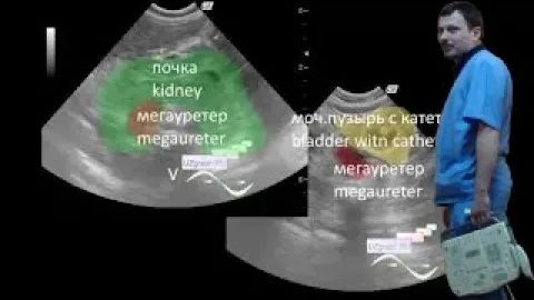 Детское УЗИ почек - Подковообразная почка и мегауретер смотреть онлайн