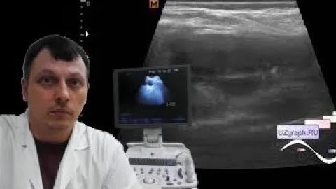 Детское УЗИ почек - "Песок" в почках смотреть онлайн