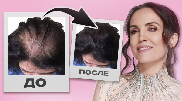 Это остановит выпадение волос НАВСЕГДА