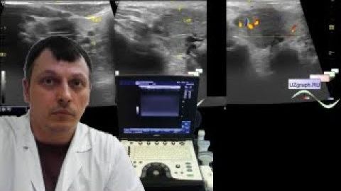 Детское УЗИ мягких тканей - Паротит/Свинка, лимфаденит шеи смотреть онлайн