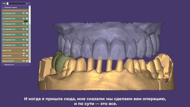 NKclinic - отзывы пациентов. Лечение запущенного пародонтита. Установка 6 имплантов и синус-лифтинг