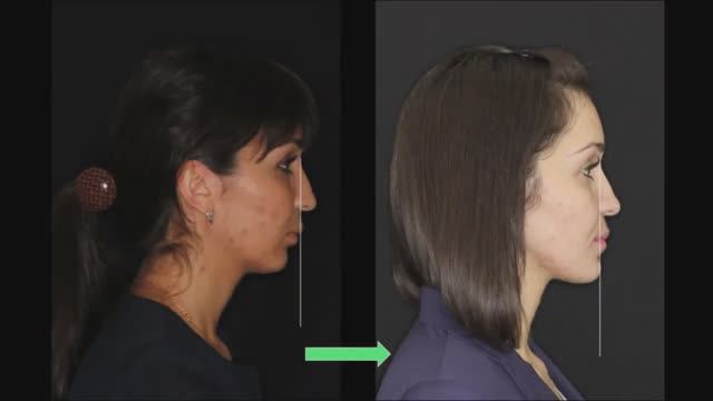 Исправление патологии ВНЧС: ортогнатическая операция и ортодонтическое лечение | NKClinic