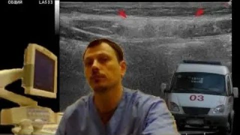 Детское УЗИ мягких тканей - Ушиб прямой мышцы живота смотреть онлайн