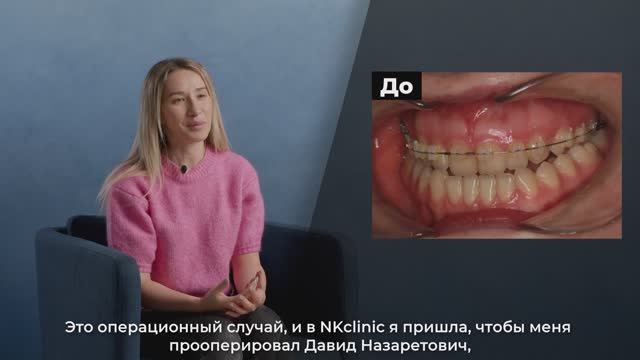 NKclinic - отзывы пациентов. Как исправить большую челюсть? До и после ортогнатической операции