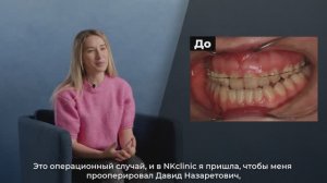 NKclinic - отзывы пациентов. Как исправить большую челюсть? До и после ортогнатической операции