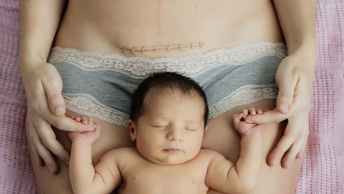 Как выглядит кесарево сечение смотреть онлайн