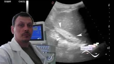 Детское УЗИ почек - Кистозная дисплазия почки смотреть онлайн