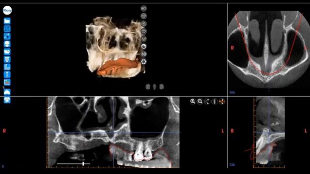 Ray — Targeted Endodontic Microsurgery Guide Workflow смотреть онлайн