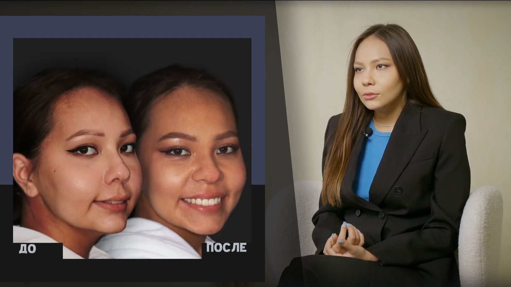 NKclinic - отзывы пациентов. После ортогнатической операции. Исправление дистального прикуса