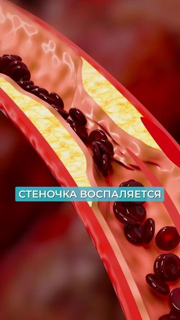Чем ОПАСЕН атеросклероз? #атеросклероз #инсульт #сосуды смотреть онлайн