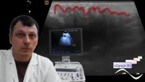 Детское УЗИ мягких тканей - "Мохнатое" образование подмышечной области смотреть онлайн