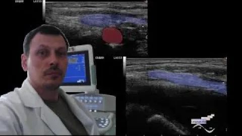 Детское УЗИ мягких тканей - Косая паховая грыжа у девочки смотреть онлайн