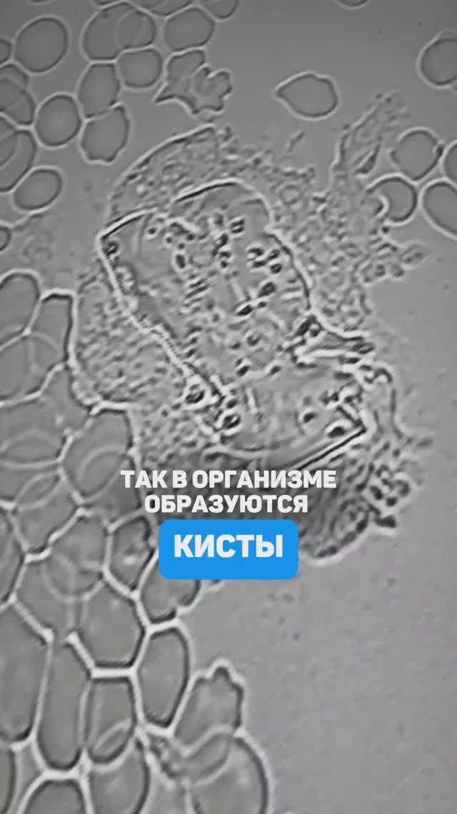 Так образуются кисты. Семейный доктор Алена Братишко смотреть онлайн