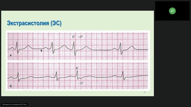 Экстрасистолия смотреть онлайн